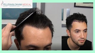 Hairline and quotTemplequot Hair Transplant  Young Patient Results  Feller amp Bloxham  NY amp Philadelphia [upl. by Ettegirb824]