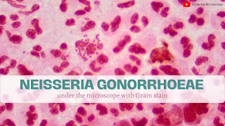 Neisseria Gonorrhoeae under the microscope with Gram stain [upl. by Mode]