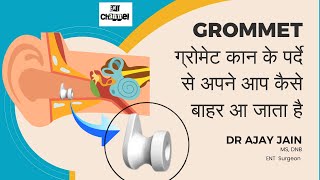 quotबच्चे के कान से निकाला Grommet देखें” grommet glueear [upl. by Limoli]