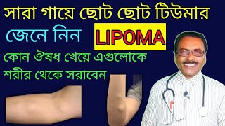 সারা গায়ে ছোট ছোট টিউমার হয়ে গেছে  কি ভাবে রক্ষা পাবেন  lipoma medicine  Dr SP Goswami [upl. by Jaal]