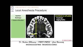 05 Complications Of Local Anesthesia Related To Utilized Technique [upl. by Eldoree14]