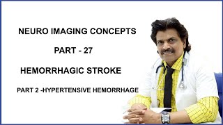 NEURO IMAGING CONCEPTS PART 27 HEMORRHAGIC STROKE PART 2  HYPERTENSIVE HEMORRHAGE [upl. by Eniloj]