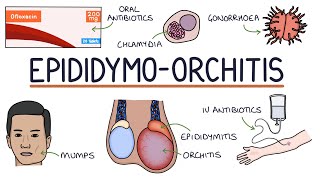 Understanding Epididymoorchitis [upl. by Roxi]