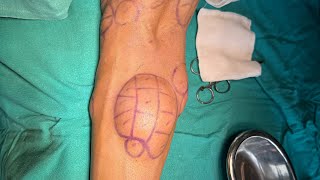 Multiple Lipoma Treatment experience Dr Ashish Bhanot [upl. by Ludvig23]