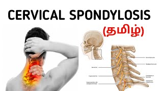 Cervical Spondylosis  Causes  Signs and Symptoms  Risk factor  Treatment  தமிழ் [upl. by Iot154]