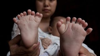 Baby Born With 31 Fingers And Toes [upl. by Aenotna]