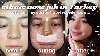 I GOT A NOSE JOB IN TURKEY  asian ethnic rhinoplasty with Dr Alpaslan Yildirim estetikburun ✿ [upl. by Calderon]