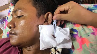 Asmr ear cleaning waxing cleaning ear asmr removal [upl. by Buttaro]