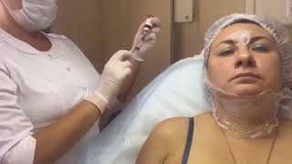 Kabelline live injection for double chin made by Russian clinic  Mediwith Korea [upl. by Neelac]