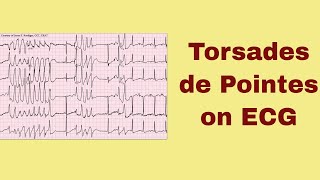 Torsade de Pointes on ECG [upl. by Siegfried]