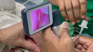 A preterm neonate is intubated using a video laryngoscope [upl. by Vine169]