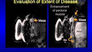 UCSF Radiology Mammography Images Revealing What Cancer Looks Like [upl. by Hannan]