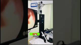 How to interpret tympanic membrane examination  DDS Traumatic perforation AOM like subscribe [upl. by Othilia]