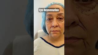 Blepharoplasty Changes Her Whole Face  She Looks 15 Years Younger 😱 facialplasticsurgery [upl. by Nylesaj]