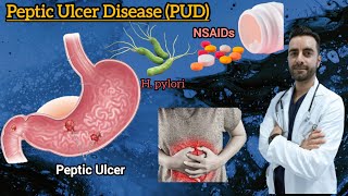 Peptic Ulcer Disease pathology  Peptic ulcer cause symptoms risk factors complication [upl. by Araes]