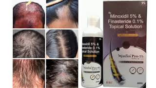 Minfin Pro 5 Topical Solution Minoxidil 5 amp Finasteride 01 Topical Solution [upl. by Loreen]