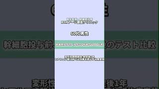 ヒアルロン酸注射では効果を感じず、当院の治療を受けた60代男性患者様の幹細胞投与前後を比較してみました。 幹細胞治療 再生医療 BTRアーツ銀座クリニック [upl. by Jovia]