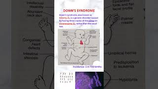 Down syndrome neet usmle pathologyacademy draditikumar [upl. by Toland190]