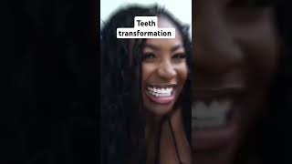 Teeth transformation [upl. by Anniala]