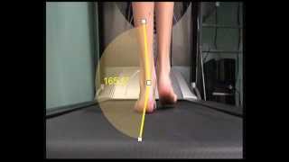 Over Pronation and how this is measured in walking [upl. by Asirehc]