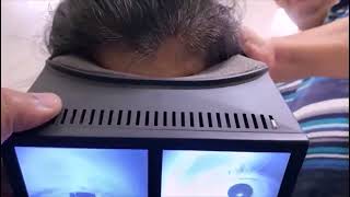 Multicanal BPPV with Canal Switch and Jam [upl. by Candra]