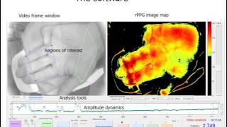 Photoplethysmography imaging algorithm for continuous monitoring of regional anesthesia [upl. by Gaby]