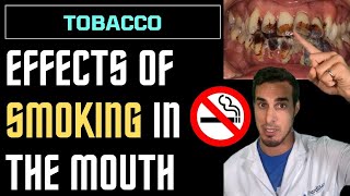 SMOKING effects on MOUTH and TEETH  consequences of TOBACCO cigarettes [upl. by Stamata]