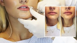 Lip Filler Experience  Start to Finish with 1 Syringe of Juvederm [upl. by Dohsar]