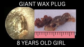 8 years old girl suffering from GIANT EARWAX PLUG [upl. by Nnateragram]