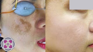 Laser Melasma amp Hyperpigmentation Treatment [upl. by Esenej745]