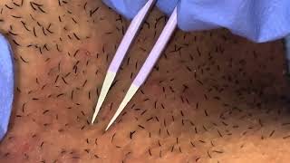 Plucking Ingrown Hairs from Neck [upl. by Neel]