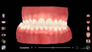 Crossbite [upl. by Teerprah]