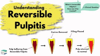 Reversible Pulpitis  Causes Diagnosis and Treatment  Endodontics [upl. by Macur]