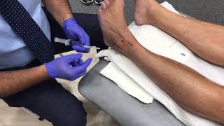 Ankle Steroid injection [upl. by Brock]