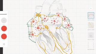 Cardiología y ECG Taquicardias supraventriculares vs ventriculares [upl. by Fugere]