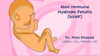 Non Immune Hydrops Fetalis NIHF TOG 2023 [upl. by Nivrad]