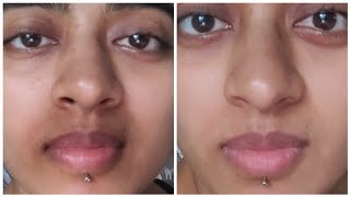 How I ACTUALLY got Rid of Pigmentation Around my Mouth  Pigmentation Treatment For Mouth Darkness [upl. by Aciamaj]