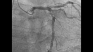 Left main PCI for complex distal trifurcation lesion with 2 stents [upl. by Anirtap]