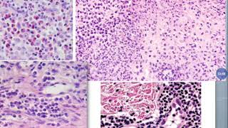 Basic Dermatopathology 3 Inflammatory infiltrate [upl. by Bryana195]