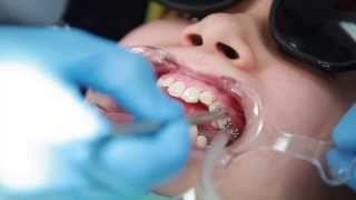 Braces Putting Braces On Bonding Procedure  Aura Orthodontics [upl. by Annoiek]