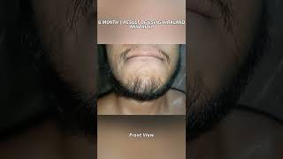 6 MONTH  Beard Journey Update [upl. by Desiri]