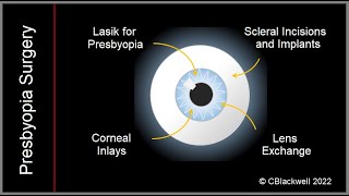 Presbyopia 3 New Treatments with Surgery [upl. by Ahsitra]