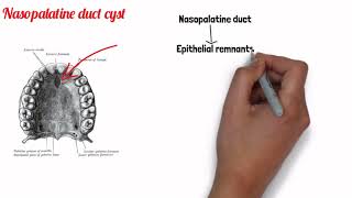 FISSURAL CYSTS  ORAL PATHOLOGY [upl. by Charisse373]