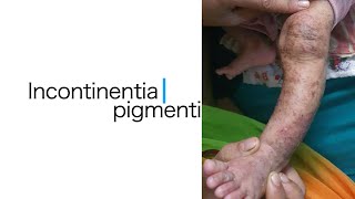 Incontinenta Pigmenti [upl. by Prissie]