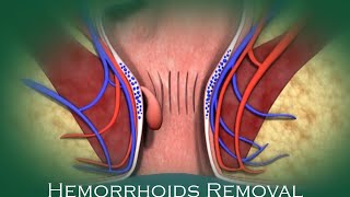 Hemorrhoids Removal  3D Animation [upl. by Sliwa]