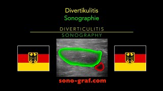 Sonographie  Divertikulitis [upl. by Aimahc]