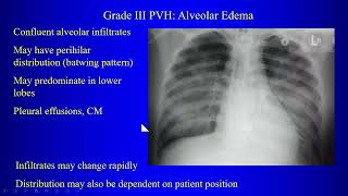 7 Pulmonary Edema [upl. by Zosi]