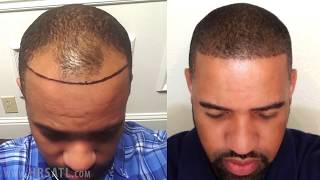 African American Hair Transplant  Before and After one year [upl. by Graner216]