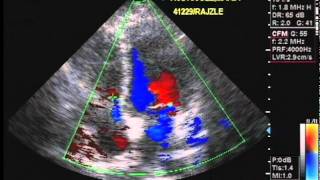 Echocardiography and Color Flow Doppler [upl. by Tully]