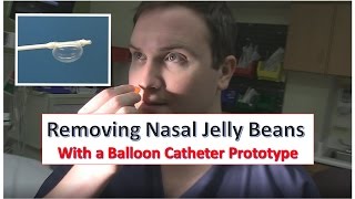 Nasal Foreign Body Balloon Catheter Prototype Trial [upl. by Tammi]